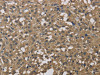 The image on the left is immunohistochemistry of paraffin-embedded Human thyroid cancer tissue using CSB-PA921442 (DCTN3 Antibody) at dilution 1/50, on the right is treated with fusion protein. (Original magnification: ×200)