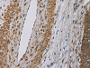 The image on the left is immunohistochemistry of paraffin-embedded Human cervical cancer tissue using CSB-PA921442 (DCTN3 Antibody) at dilution 1/50, on the right is treated with fusion protein. (Original magnification: ×200)