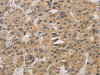 The image on the left is immunohistochemistry of paraffin-embedded Human liver cancer tissue using CSB-PA151075 (DDIT4 Antibody) at dilution 1/30, on the right is treated with fusion protein. (Original magnification: ×200)