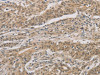 The image on the left is immunohistochemistry of paraffin-embedded Human gastric cancer tissue using CSB-PA151075 (DDIT4 Antibody) at dilution 1/30, on the right is treated with fusion protein. (Original magnification: ×200)
