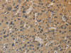 The image on the left is immunohistochemistry of paraffin-embedded Human liver cancer tissue using CSB-PA938110 (DDX19B Antibody) at dilution 1/20, on the right is treated with fusion protein. (Original magnification: ×200)