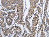 The image on the left is immunohistochemistry of paraffin-embedded Human breast cancer tissue using CSB-PA025645 (DSG2 Antibody) at dilution 1/50, on the right is treated with fusion protein. (Original magnification: ×200)