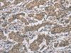 The image on the left is immunohistochemistry of paraffin-embedded Human gastric cancer tissue using CSB-PA025645 (DSG2 Antibody) at dilution 1/50, on the right is treated with fusion protein. (Original magnification: ×200)