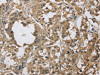 The image on the left is immunohistochemistry of paraffin-embedded Human thyroid cancer tissue using CSB-PA401715 (DSG2 Antibody) at dilution 1/70, on the right is treated with fusion protein. (Original magnification: ×200)