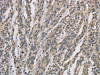 The image on the left is immunohistochemistry of paraffin-embedded Human esophagus cancer tissue using CSB-PA401715 (DSG2 Antibody) at dilution 1/70, on the right is treated with fusion protein. (Original magnification: ×200)