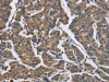 The image on the left is immunohistochemistry of paraffin-embedded Human breast cancer tissue using CSB-PA283024 (DHRS3 Antibody) at dilution 1/30, on the right is treated with fusion protein. (Original magnification: ×200)