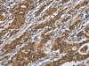 The image on the left is immunohistochemistry of paraffin-embedded Human gastric cancer tissue using CSB-PA283024 (DHRS3 Antibody) at dilution 1/30, on the right is treated with fusion protein. (Original magnification: ×200)