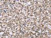 The image on the left is immunohistochemistry of paraffin-embedded Human prostate cancer tissue using CSB-PA078374 (DYNLL1 Antibody) at dilution 1/25, on the right is treated with fusion protein. (Original magnification: ×200)