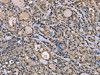 The image on the left is immunohistochemistry of paraffin-embedded Human thyroid cancer tissue using CSB-PA244606 (DYNLL1 Antibody) at dilution 1/30, on the right is treated with fusion protein. (Original magnification: ×200)