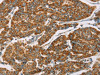 The image on the left is immunohistochemistry of paraffin-embedded Human breast cancer tissue using CSB-PA073786 (DLL4 Antibody) at dilution 1/40, on the right is treated with fusion protein. (Original magnification: ×200)