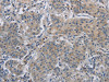 The image on the left is immunohistochemistry of paraffin-embedded Human gastric cancer tissue using CSB-PA727123 (DNAJB4 Antibody) at dilution 1/50, on the right is treated with fusion protein. (Original magnification: ×200)