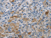 The image on the left is immunohistochemistry of paraffin-embedded Human liver cancer tissue using CSB-PA727123 (DNAJB4 Antibody) at dilution 1/50, on the right is treated with fusion protein. (Original magnification: ×200)
