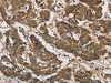 The image on the left is immunohistochemistry of paraffin-embedded Human colon cancer tissue using CSB-PA245297 (UBE2S Antibody) at dilution 1/40, on the right is treated with fusion protein. (Original magnification: ×200)