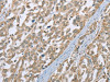 The image on the left is immunohistochemistry of paraffin-embedded Human esophagus cancer tissue using CSB-PA568195 (ECHS1 Antibody) at dilution 1/35, on the right is treated with fusion protein. (Original magnification: ×200)