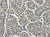 The image on the left is immunohistochemistry of paraffin-embedded Human breast cancer tissue using CSB-PA367981 (RNASE3 Antibody) at dilution 1/20, on the right is treated with fusion protein. (Original magnification: ×200)