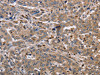 The image on the left is immunohistochemistry of paraffin-embedded Human liver cancer tissue using CSB-PA039309 (EDA Antibody) at dilution 1/30, on the right is treated with fusion protein. (Original magnification: ×200)