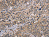 The image on the left is immunohistochemistry of paraffin-embedded Human cervical cancer tissue using CSB-PA039309 (EDA Antibody) at dilution 1/30, on the right is treated with fusion protein. (Original magnification: ×200)