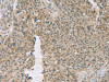 The image on the left is immunohistochemistry of paraffin-embedded Human ovarian cancer tissue using CSB-PA931107 (EDIL3 Antibody) at dilution 1/20, on the right is treated with fusion protein. (Original magnification: ×200)