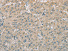 The image on the left is immunohistochemistry of paraffin-embedded Human liver cancer tissue using CSB-PA994433 (EEF2 Antibody) at dilution 1/20, on the right is treated with fusion protein. (Original magnification: ×200)