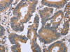 The image on the left is immunohistochemistry of paraffin-embedded Human colon cancer tissue using CSB-PA064264 (KIAA1324 Antibody) at dilution 1/30, on the right is treated with fusion protein. (Original magnification: ×200)