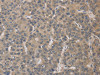 The image on the left is immunohistochemistry of paraffin-embedded Human liver cancer tissue using CSB-PA934646 (ELOVL1 Antibody) at dilution 1/30, on the right is treated with fusion protein. (Original magnification: ×200)