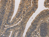 The image on the left is immunohistochemistry of paraffin-embedded Human colon cancer tissue using CSB-PA939360 (ELOVL1 Antibody) at dilution 1/50, on the right is treated with fusion protein. (Original magnification: ×200)