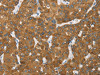 The image on the left is immunohistochemistry of paraffin-embedded Human liver cancer tissue using CSB-PA023517 (ENTPD5 Antibody) at dilution 1/20, on the right is treated with fusion protein. (Original magnification: ×200)