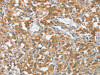 The image on the left is immunohistochemistry of paraffin-embedded Human thyroid cancer tissue using CSB-PA023517 (ENTPD5 Antibody) at dilution 1/20, on the right is treated with fusion protein. (Original magnification: ×200)