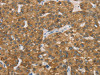 The image on the left is immunohistochemistry of paraffin-embedded Human liver cancer tissue using CSB-PA929748 (ENTPD5 Antibody) at dilution 1/20, on the right is treated with fusion protein. (Original magnification: ×200)