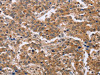 The image on the left is immunohistochemistry of paraffin-embedded Human liver cancer tissue using CSB-PA010637 (EPDR1 Antibody) at dilution 1/40, on the right is treated with fusion protein. (Original magnification: ×200)