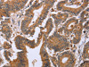 The image on the left is immunohistochemistry of paraffin-embedded Human colon cancer tissue using CSB-PA283664 (EPDR1 Antibody) at dilution 1/20, on the right is treated with fusion protein. (Original magnification: ×200)