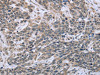 The image on the left is immunohistochemistry of paraffin-embedded Human cervical cancer tissue using CSB-PA135769 (ESR2 Antibody) at dilution 1/30, on the right is treated with fusion protein. (Original magnification: ×200)