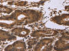 The image on the left is immunohistochemistry of paraffin-embedded Human colon cancer tissue using CSB-PA161267 (EDN2 Antibody) at dilution 1/30, on the right is treated with fusion protein. (Original magnification: ×200)
