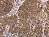 The image on the left is immunohistochemistry of paraffin-embedded Human cervical cancer tissue using CSB-PA033256 (EDN2 Antibody) at dilution 1/30, on the right is treated with fusion protein. (Original magnification: ×200)