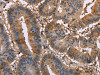 The image on the left is immunohistochemistry of paraffin-embedded Human colon cancer tissue using CSB-PA033256 (EDN2 Antibody) at dilution 1/30, on the right is treated with fusion protein. (Original magnification: ×200)