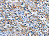 The image on the left is immunohistochemistry of paraffin-embedded Human thyroid cancer tissue using CSB-PA808765 (ETHE1 Antibody) at dilution 1/20, on the right is treated with fusion protein. (Original magnification: ×200)