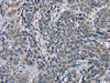 The image on the left is immunohistochemistry of paraffin-embedded Human cervical cancer tissue using CSB-PA979712 (BMX Antibody) at dilution 1/30, on the right is treated with fusion protein. (Original magnification: ×200)