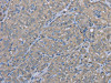 The image on the left is immunohistochemistry of paraffin-embedded Human thyroid cancer tissue using CSB-PA115608 (EZR Antibody) at dilution 1/30, on the right is treated with fusion protein. (Original magnification: ×200)