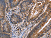 The image on the left is immunohistochemistry of paraffin-embedded Human colon cancer tissue using CSB-PA969975 (FAAH2 Antibody) at dilution 1/30, on the right is treated with fusion protein. (Original magnification: ×200)