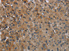 The image on the left is immunohistochemistry of paraffin-embedded Human liver cancer tissue using CSB-PA277783 (FAAH Antibody) at dilution 1/50, on the right is treated with fusion protein. (Original magnification: ×200)