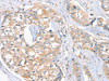 The image on the left is immunohistochemistry of paraffin-embedded Human breast cancer tissue using CSB-PA127416 (FAIM3 Antibody) at dilution 1/20, on the right is treated with fusion protein. (Original magnification: ×200)