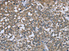 The image on the left is immunohistochemistry of paraffin-embedded Human cervical cancer tissue using CSB-PA914875 (PTK2B Antibody) at dilution 1/50, on the right is treated with fusion protein. (Original magnification: ×200)