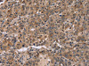 The image on the left is immunohistochemistry of paraffin-embedded Human liver cancer tissue using CSB-PA118886 (FAM107A Antibody) at dilution 1/30, on the right is treated with fusion protein. (Original magnification: ×200)