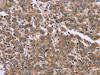 The image on the left is immunohistochemistry of paraffin-embedded Human liver cancer tissue using CSB-PA015538 (FAM3B Antibody) at dilution 1/30, on the right is treated with fusion protein. (Original magnification: ×200)