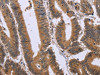 The image on the left is immunohistochemistry of paraffin-embedded Human colon cancer tissue using CSB-PA015538 (FAM3B Antibody) at dilution 1/30, on the right is treated with fusion protein. (Original magnification: ×200)