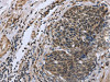 The image on the left is immunohistochemistry of paraffin-embedded Human cervical cancer tissue using CSB-PA098906 (FANCG Antibody) at dilution 1/50, on the right is treated with fusion protein. (Original magnification: ×200)