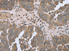 The image on the left is immunohistochemistry of paraffin-embedded Human ovarian cancer tissue using CSB-PA098906 (FANCG Antibody) at dilution 1/50, on the right is treated with fusion protein. (Original magnification: ×200)