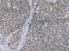 The image on the left is immunohistochemistry of paraffin-embedded Human cervical cancer tissue using CSB-PA272939 (FANCG Antibody) at dilution 1/30, on the right is treated with fusion protein. (Original magnification: ×200)