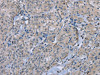 The image on the left is immunohistochemistry of paraffin-embedded Human thyroid cancer tissue using CSB-PA699536 (FAP Antibody) at dilution 1/30, on the right is treated with fusion protein. (Original magnification: ×200)
