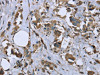 The image on the left is immunohistochemistry of paraffin-embedded Human breast cancer tissue using CSB-PA042133 (MYL12B Antibody) at dilution 1/20, on the right is treated with fusion protein. (Original magnification: ×200)